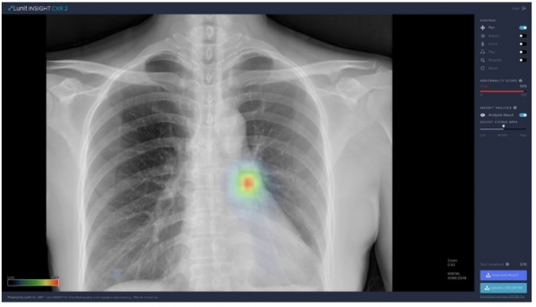 루닛의 폐 질환 진단 보조 AI 소프트웨어인 ‘루닛 인사이트 CXR’. 인공지능을 활용해 흉부 엑스레이의 비정상 소견을 표시한다. [루닛 제공]